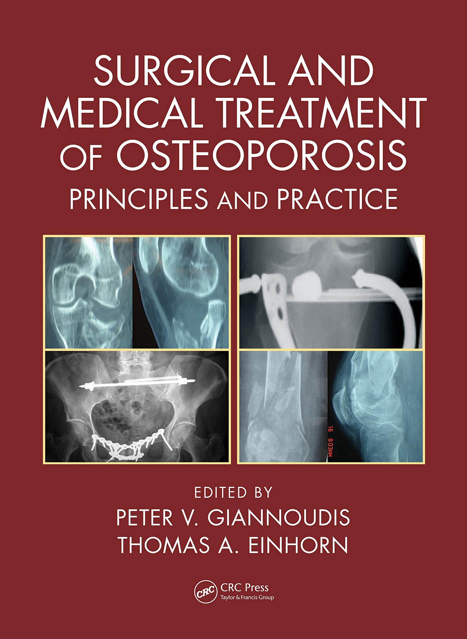 Surgical and Medical Treatment of Osteoporosis: Principles and Practice - 1st Edition